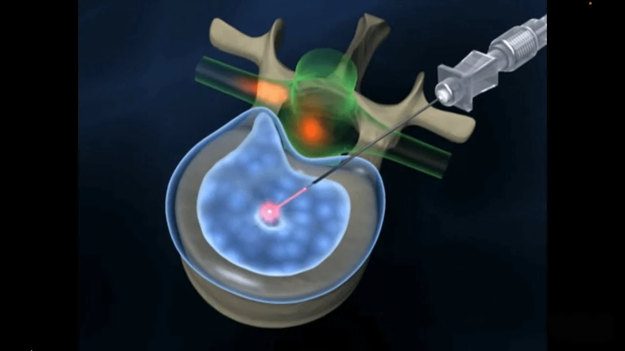 Percutaneous Laser Disc Decompression (PLDD)